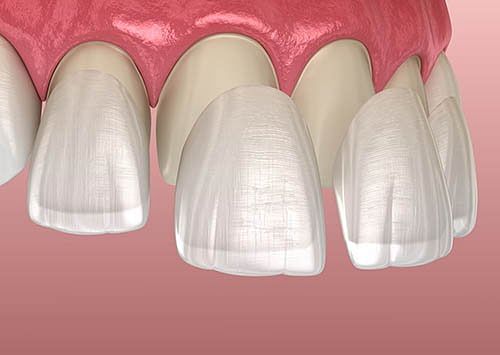  dental veneers