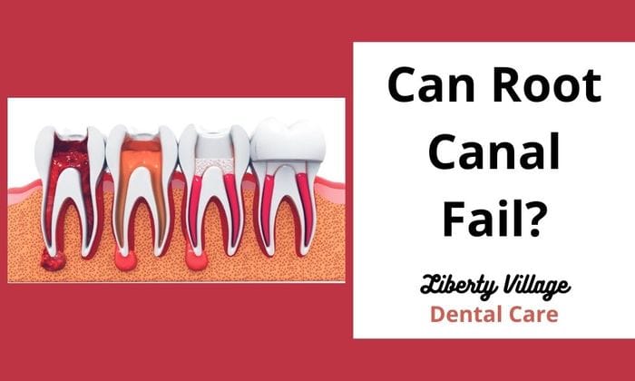 Root Canal Symptoms Of Failing