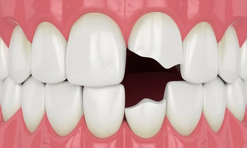Chipped Tooth Repair. Do I Really Need It? - Guzaitis Dental Group